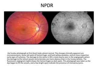 NPDR
the fundus photograph at first blush looks almost normal. The changes clinically apparent are
microaneurysms, some red spots of hemorrhage, and hard yellow exudates, and on close inspection
early signs of ischemia. The damage to the retina in DR is most clearly seen in the angiographs where
the damage to the retinal vessels and arterioles are more obvious than in the fundus photos. The
fluorescein angiogram (right) shows the hemorrhages as dark spots. This photograph was taken as the
dye began to fill the vessels, and a few bright spots indicate the presence of microaneurysms.
 