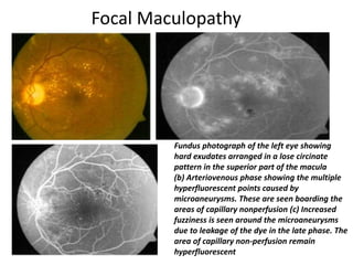 Focal Maculopathy
Fundus photograph of the left eye showing
hard exudates arranged in a lose circinate
pattern in the superior part of the macula
(b) Arteriovenous phase showing the multiple
hyperfluorescent points caused by
microaneurysms. These are seen boarding the
areas of capillary nonperfusion (c) Increased
fuzziness is seen around the microaneurysms
due to leakage of the dye in the late phase. The
area of capillary non-perfusion remain
hyperfluorescent
 