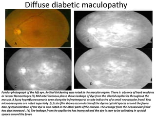 Diffuse diabetic maculopathy
Fundus photograph of the left eye. Retinal thickening was noted in the macular region. There is absence of hard exudates
or retinal Hemorrhages (b) Mid arteriovenous phase shows leakage of dye from the dilated capillaries throughout the
macula. A fuzzy hyperfluorescence is seen along the inferotemporal arcade indicative of a small neovascular frond. Few
microaneurysms are noted superiorly .(c ) Late film shows accumulation of the dye in cystoid spaces around the fovea.
Non-cystoid collection of the dye is also noted in the other parts ofthe macula. The leakage from the neovascular frond
has also increased . (d) The leakage from the capillaries has increased and the dye is seen to be collecting in cystoid
spaces around the fovea
A
B
C
D
 
