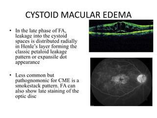 CYSTOID MACULAR EDEMA
• In the late phase of FA,
leakage into the cystoid
spaces is distributed radially
in Henle’s layer forming the
classic petaloid leakage
pattern or expansile dot
appearance
• Less common but
pathognomonic for CME is a
smokestack pattern. FA can
also show late staining of the
optic disc
 