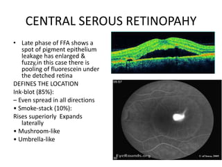 CENTRAL SEROUS RETINOPAHY
• Late phase of FFA shows a
spot of pigment epithelium
leakage has enlarged &
fuzzy,in this case there is
pooling of fluorescein under
the detched retina
DEFINES THE LOCATION
Ink-blot (85%):
– Even spread in all directions
• Smoke-stack (10%):
Rises superiorly Expands
laterally
• Mushroom-like
• Umbrella-like
 
