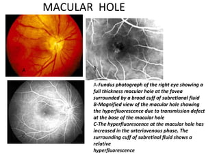 MACULAR HOLE
A-Fundus photograph of the right eye showing a
full thickness macular hole at the fovea
surrounded by a broad cuff of subretianal fluid
B-Magnified view of the macular hole showing
the hyperfluorescence due to transmission defect
at the base of the macular hole
C-The hyperfluorescence at the macular hole has
increased in the arteriovenous phase. The
surrounding cuff of subretinal fluid shows a
relative
hyperfluorescence
A B
C
 