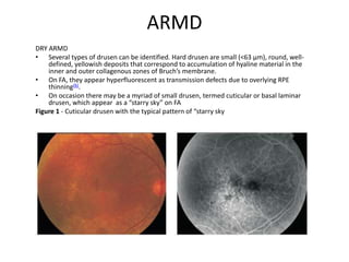 ARMD
DRY ARMD
• Several types of drusen can be identified. Hard drusen are small (<63 µm), round, well-
defined, yellowish deposits that correspond to accumulation of hyaline material in the
inner and outer collagenous zones of Bruch’s membrane.
• On FA, they appear hyperfluorescent as transmission defects due to overlying RPE
thinning(6).
• On occasion there may be a myriad of small drusen, termed cuticular or basal laminar
drusen, which appear as a “starry sky” on FA
Figure 1 - Cuticular drusen with the typical pattern of “starry sky
 