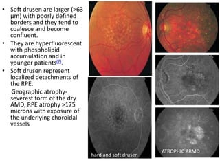 • Soft drusen are larger (>63
µm) with poorly defined
borders and they tend to
coalesce and become
confluent.
• They are hyperfluorescent
with phospholipid
accumulation and in
younger patients(7).
• Soft drusen represent
localized detachments of
the RPE.
Geographic atrophy-
severest form of the dry
AMD, RPE atrophy >175
microns with exposure of
the underlying choroidal
vessels
ATROPHIC ARMD
f hard and soft drusen
 