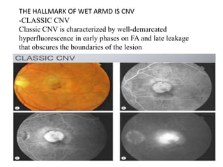 THE HALLMARK OF WET ARMD IS CNV
-CLASSIC CNV
Classic CNV is characterized by well-demarcated
hyperfluorescence in early phases on FA and late leakage
that obscures the boundaries of the lesion
-
 