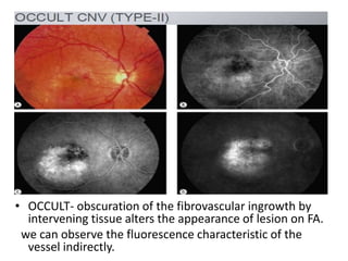 • OCCULT- obscuration of the fibrovascular ingrowth by
intervening tissue alters the appearance of lesion on FA.
we can observe the fluorescence characteristic of the
vessel indirectly.
 