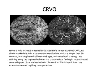 CRVO
reveal a mild increase in retinal circulation time. In non-ischemic CRVO, FA
shows marked delay in arteriovenous transit time, which is longer than 20
seconds, masking by retinal haemorrhages, and vessel wall staining. Late
staining along the large retinal veins is a characteristic finding in moderate and
severe degrees of central retinal vein obstruction. The ischemic form has
extensive areas of capillary non- perfusion
 