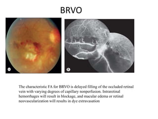 BRVO
The characteristic FA for BRVO is delayed filling of the occluded retinal
vein with varying degrees of capillary nonperfusion. Intraretinal
hemorrhages will result in blockage, and macular edema or retinal
neovascularization will results in dye extravasation
 