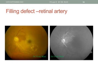 Window Defect Ffa Hyper DR WANI'S TALK ON Fundus fluorescein angiography PART II for post ...
