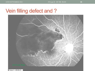 Window Defect Ffa Hyper DR WANI'S TALK ON Fundus fluorescein angiography PART II for post ...