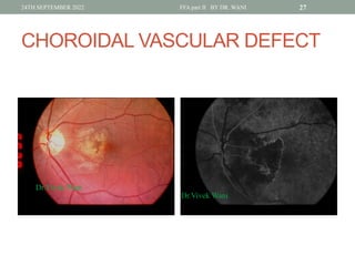 Window Defect Ffa Hyper DR WANI'S TALK ON Fundus fluorescein angiography PART II for post ...