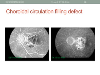 Window Defect Ffa Hyper DR WANI'S TALK ON Fundus fluorescein angiography PART II for post ...