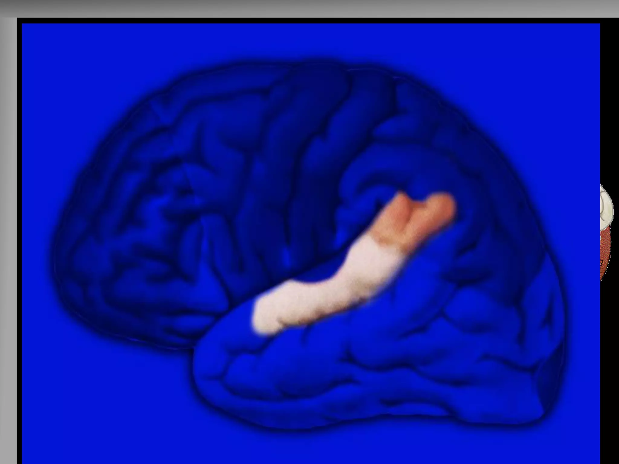 Afasia de Wernicke (lado dominante) 
-Não compreende a linguagem falada - Fala fluentemente mas sem relação com a pergunta ****PREJUÍZO DO DIÁLOGO  