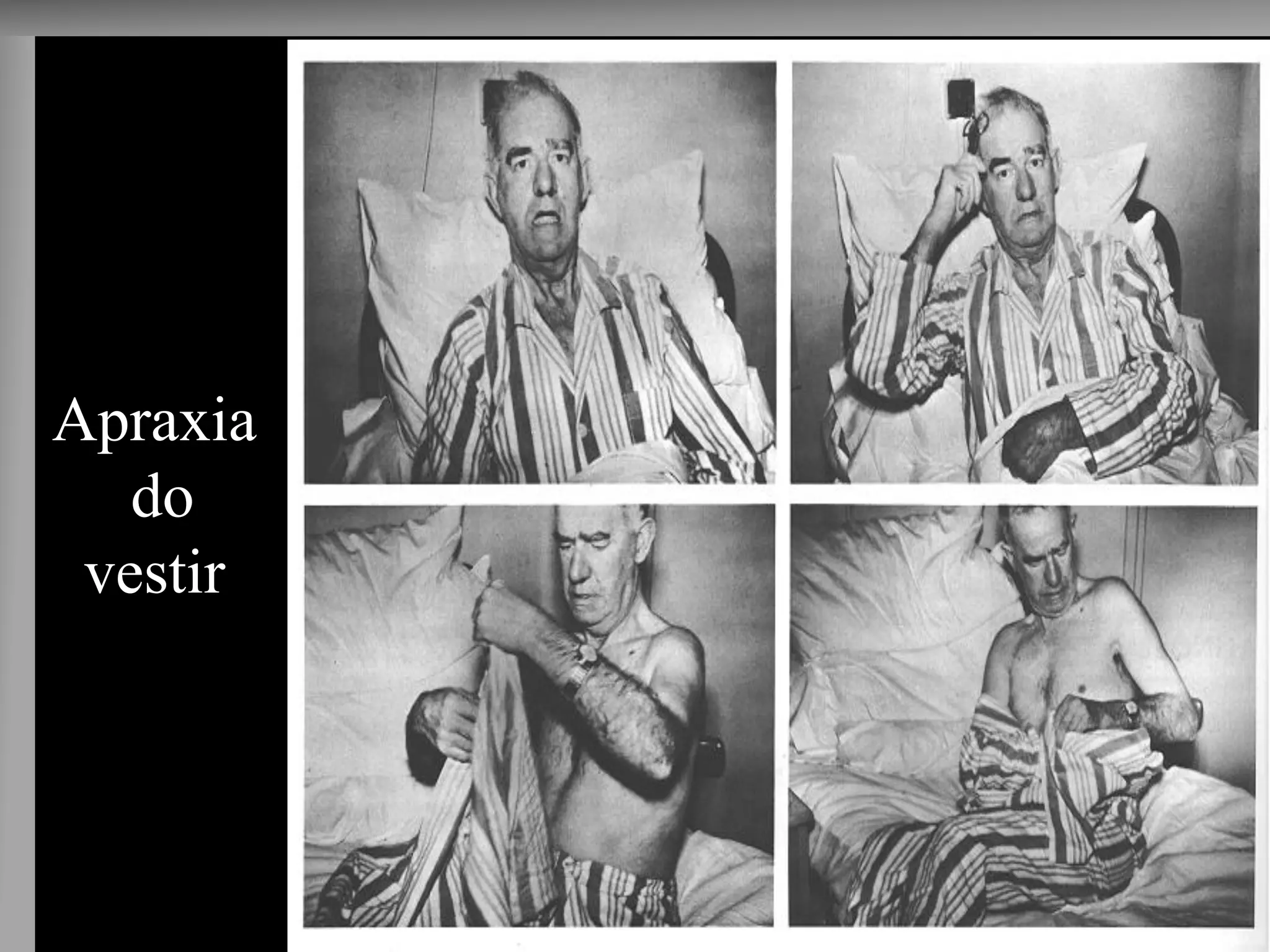 Apraxia 
do 
vestir 
Lesão Hem.D  