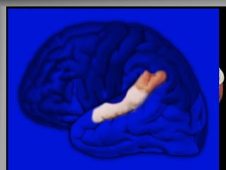 Afasia de Wernicke (lado dominante) 
-Não compreende a linguagem falada - Fala fluentemente mas sem relação com a pergunta ****PREJUÍZO DO DIÁLOGO  