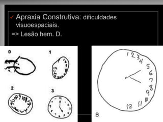 Apraxia Construtiva: dificuldades visuoespaciais. 
=> Lesão hem. D.  
