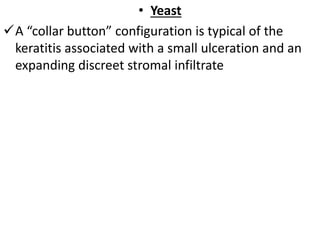 • Yeast
A “collar button” configuration is typical of the
keratitis associated with a small ulceration and an
expanding discreet stromal infiltrate
 