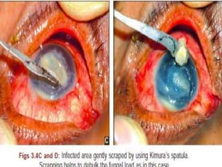 INVESTIGATIONS
1. Scraping
• aim :to debulk the organisms,
to diagnose the organism
to decrease the barrier for entry of antifungal
procedure
– aseptic precautions
– topical anesthesia
– leading edge & base debrided with spatula,sx blade,
diamond tipped motorized burr.
 