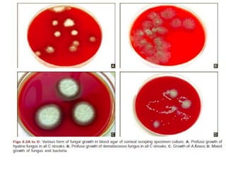 • A definitive diagnosis of fungal keratitis is made if
1. Corneal scrapings reveal fungal elements in smears,
2. Fungus grows in more than one medium in the
absence of fungus in smears,
3. Fungus grows on a single medium in the presence
of fungus in smears,
4. Confluent growth of fungus appears at the
inoculated site on a single solid medium.
• incubated for 10 days to facilitate sporulation.
• +ve test yielded : 3 days (83%) ,>1 wk(97%).
• no growth :in 1 wk & reported in 3 wks
• identification based on its macroscopic and
microscopic features.
 