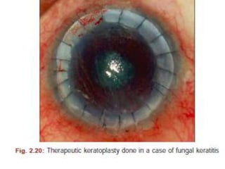 Fungal corneal ulcer