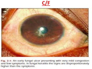 C/F
• SYMPTOMS (RELATIVELY LESS)
• insidious onset
• nonspecific symptoms
• duration : 5-10 days
• Fb sensation & Slow onset of pain
• decreased vision if on visual axis.
 