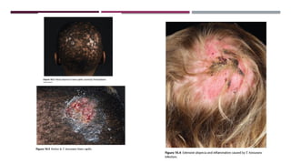 Fungal-Infections.pptx- fungal infections a lecture for students | PPTX