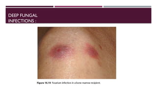 Fungal-Infections.pptx- fungal infections a lecture for students | PPTX