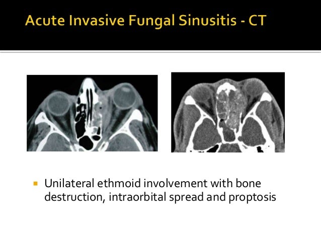 Fungal Sinusitis Fungal Sinusitis