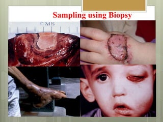 Sampling using Biopsy
 