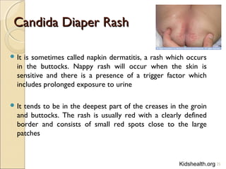 Candida Diaper RashCandida Diaper Rash
 It is sometimes called napkin dermatitis, a rash which occurs
in the buttocks. Nappy rash will occur when the skin is
sensitive and there is a presence of a trigger factor which
includes prolonged exposure to urine
 It tends to be in the deepest part of the creases in the groin
and buttocks. The rash is usually red with a clearly defined
border and consists of small red spots close to the large
patches
25Kidshealth.org
 