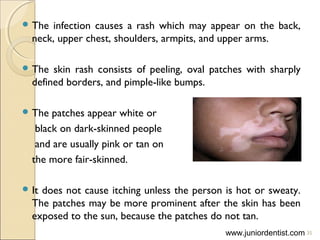  The infection causes a rash which may appear on the back,
neck, upper chest, shoulders, armpits, and upper arms.
 The skin rash consists of peeling, oval patches with sharply
defined borders, and pimple-like bumps.
 The patches appear white or
black on dark-skinned people
and are usually pink or tan on
the more fair-skinned.
 It does not cause itching unless the person is hot or sweaty.
The patches may be more prominent after the skin has been
exposed to the sun, because the patches do not tan.
35www.juniordentist.com
 