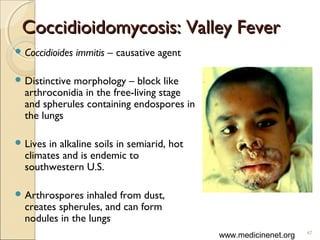 Coccidioidomycosis: Valley FeverCoccidioidomycosis: Valley Fever
 Coccidioides immitis – causative agent
 Distinctive morphology – block like
arthroconidia in the free-living stage
and spherules containing endospores in
the lungs
 Lives in alkaline soils in semiarid, hot
climates and is endemic to
southwestern U.S.
 Arthrospores inhaled from dust,
creates spherules, and can form
nodules in the lungs
47
www.medicinenet.org
 