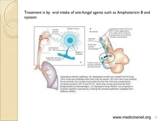 Treatment is by oral intake of anti-fungal agents such as Amphotericin B and
nystatin
58www.medicinenet.org
 