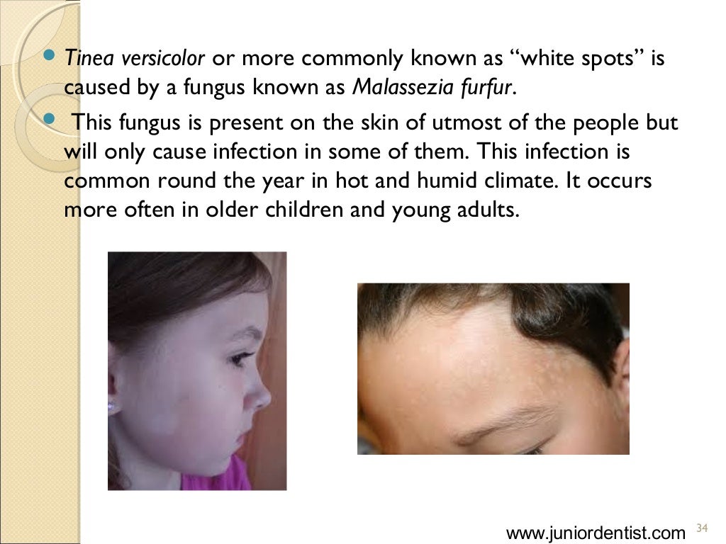 Fungal diseases in children