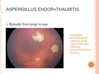 ASPERGILLUS ENDOPHTHALMITIS
 Spreads from lungs to eye
Aspergillus
endophthalmitis
(infection of the
retina of the eye),
following
dissemination from
the lung.
 