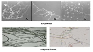 Fungal Infection
False-positive Structures
 