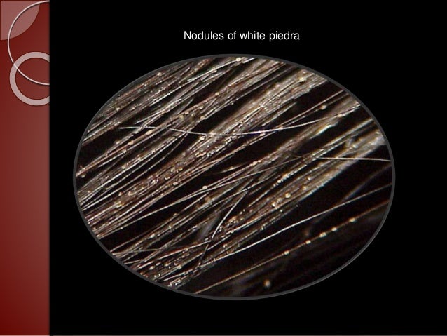 fungal infection in hair