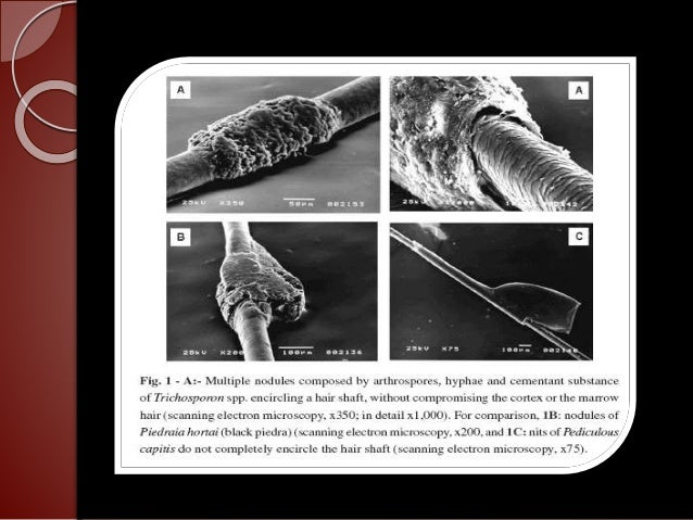 Fungal Infection In Hair
