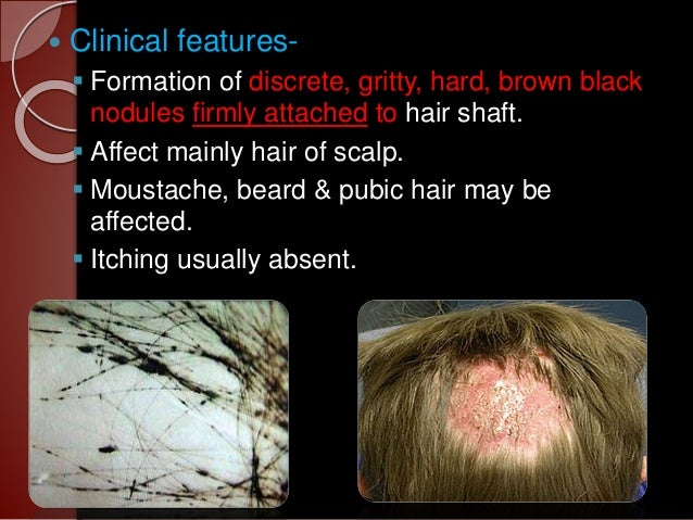 fungal infection in hair