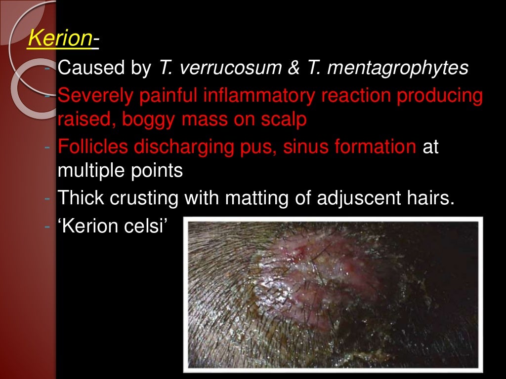 Fungal infection in hair