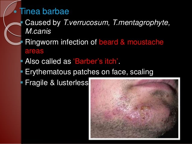 Fungal Infection In Hair