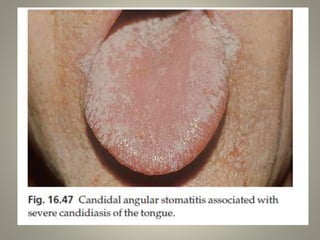 Fungal infections