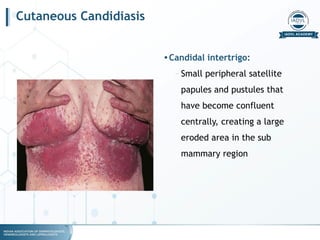 fungal infections for dermatology.pptx.pdf