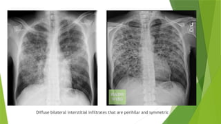 INFECTIOUS DISEASES COMMON FUNFGAL INFECTIONS | PPTX