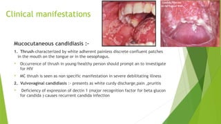 INFECTIOUS DISEASES COMMON FUNFGAL INFECTIONS | PPTX