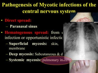 Pathogenesis of Mycotic infections of the
        central nervous system
• Direct spread:
  – Paranasal sinus
• Hematogenous spread: from extrtacranial fungal
  infection or opportunistic infection
  – Superficial mycosis: skin, hair, nails, mucous
    membrane
  – Deep mycosis: Subcutaneous & deeper tissue
  – Systemic mycosis: pulmonary infection
 