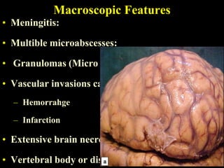 Macroscopic Features
• Meningitis:

• Multible microabscesses:

• Granulomas (Micro or macro):

• Vascular invasions causing areas of:
  – Hemorrahge

  – Infarction

• Extensive brain necrosis

• Vertebral body or disc infection
 