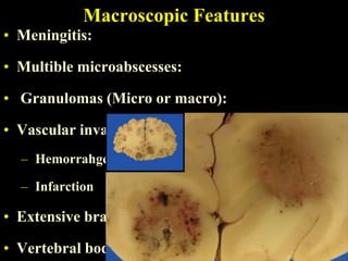 Macroscopic Features
• Meningitis:

• Multible microabscesses:

• Granulomas (Micro or macro):

• Vascular invasions causing areas of:
  – Hemorrahge

  – Infarction

• Extensive brain necrosis

• Vertebral body or disc infection
 
