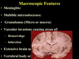 Macroscopic Features
• Meningitis:

• Multible microabscesses:

• Granulomas (Micro or macro):

• Vascular invasions causing areas of:
  – Hemorrahge

  – Infarction

• Extensive brain necrosis

• Vertebral body or disc infection
 