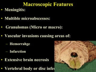 Macroscopic Features
• Meningitis:

• Multible microabscesses:

• Granulomas (Micro or macro):

• Vascular invasions causing areas of:
  – Hemorrahge

  – Infarction

• Extensive brain necrosis

• Vertebral body or disc infection
 